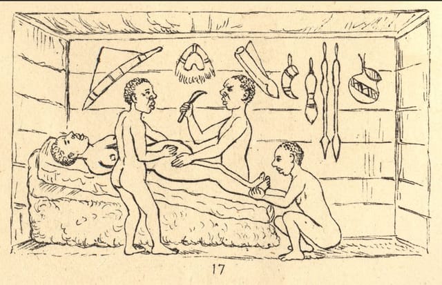 Caesarean Operations Were Performed in Pre-Colonial Uganda